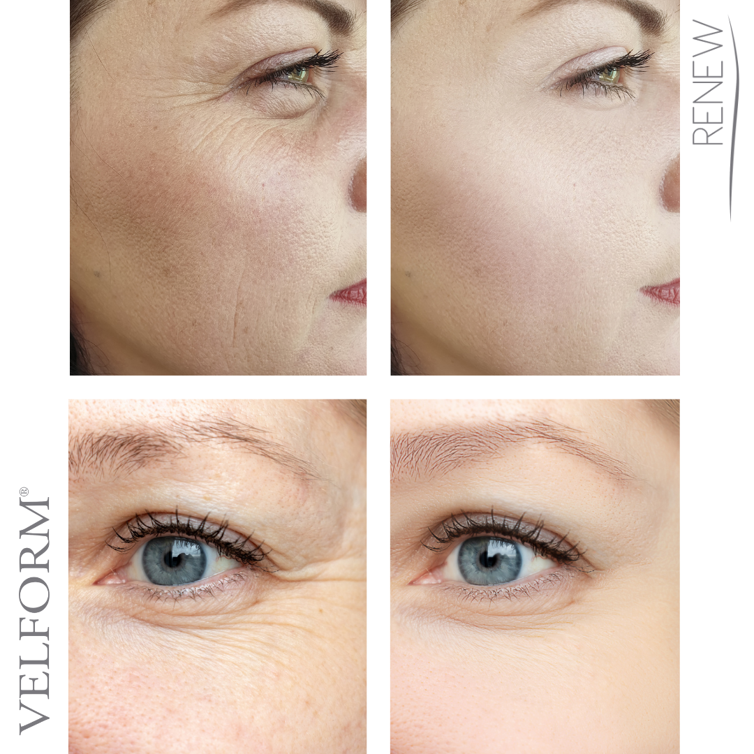 ✨ Tratamiento Facial Antiaging con Colágeno + Ácido Hialurónico ✨